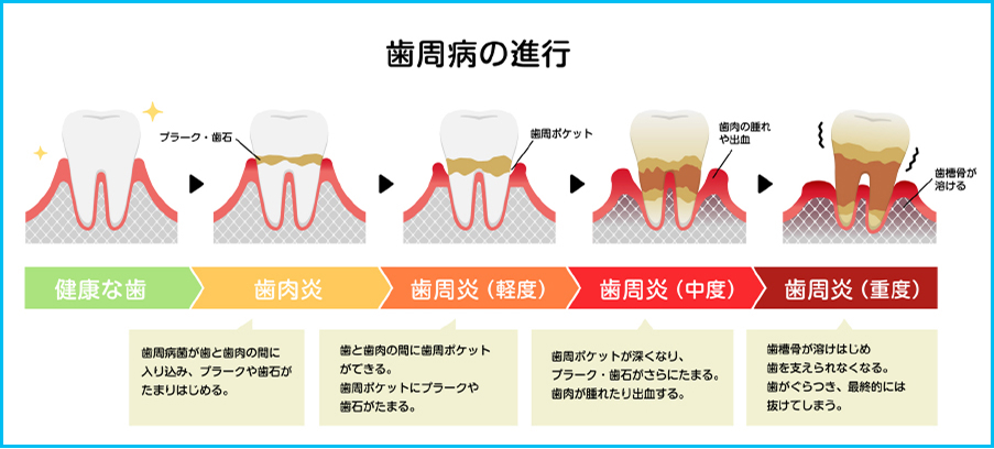 歯周病の原因