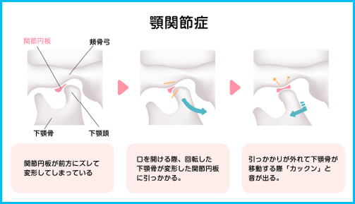 顎関節症