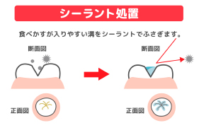 シーラント